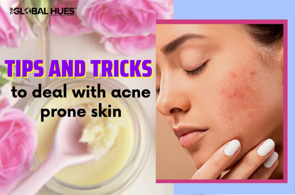 Tips and Tricks To Deal With Acne prone and Sensitive skin