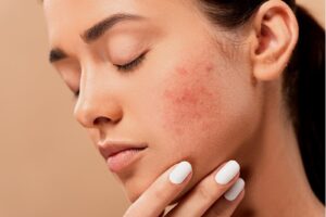 acne treatment | TIPS AND TRICKS TO DEAL WITH ACNE-PRONE AND SENSITIVE SKIN