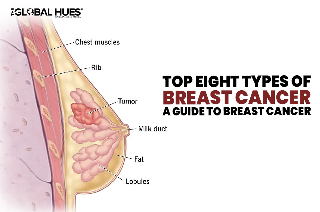 Top Eight Types Of Breast Cancer A Guide To Breast Cancer